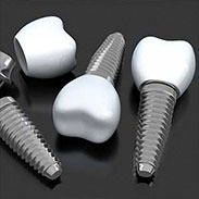 Dental Implants in Manhattan